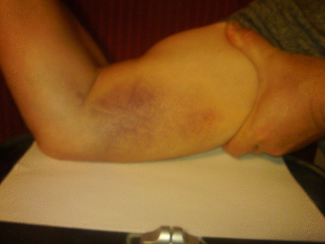 Ruptured bicep, small head, three days after accident