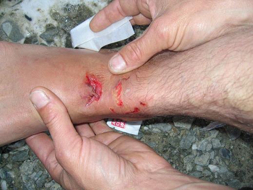 Jason's Slider injury